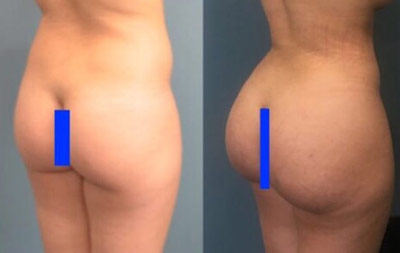 butt lift plastic surgery gallery