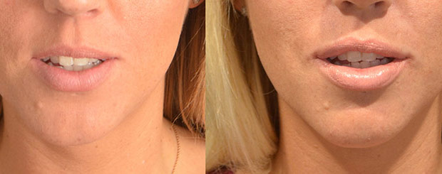 lips enhancement gallery