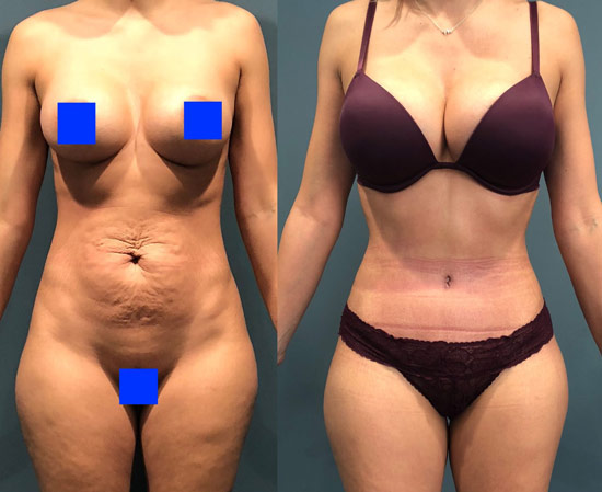 tummy tuck gallery